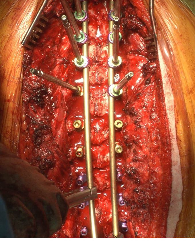 Intraoperative view of scoliosis surgery
