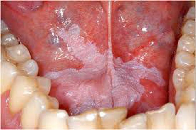 Treatment for leukoplakia