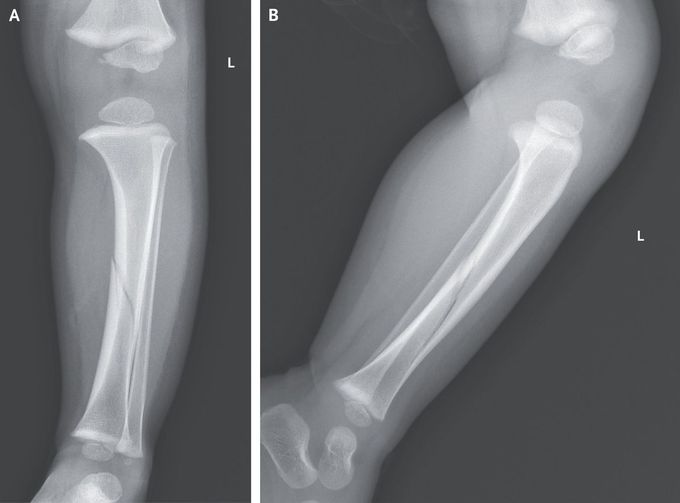 Toddler’s Fracture