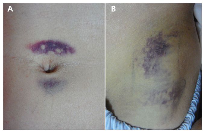 2 signs for Acute Pancreatitis