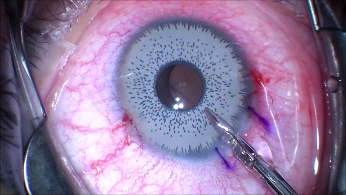 Want to change your eye color? Think twice.. Iris Implant Removal!