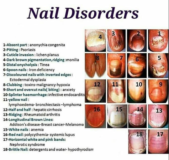 Nail disorders