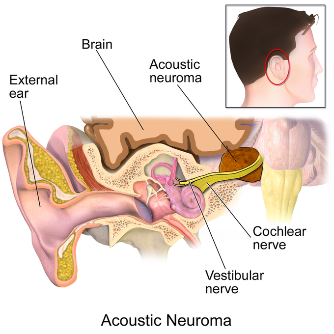 What causes acoustic neuroma?