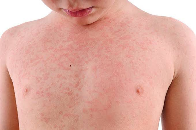 Complications of measles