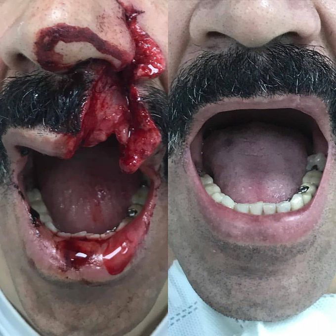 This is what happens when you use an angle grinder without a face shield for protection! 