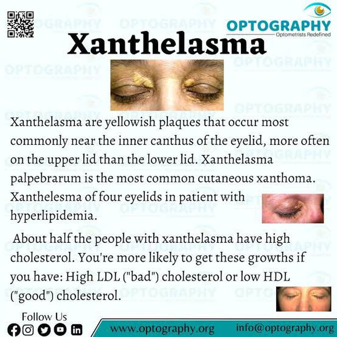 Xanthelasma