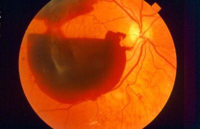 Retinopatía diabética + hemorragia vítrea