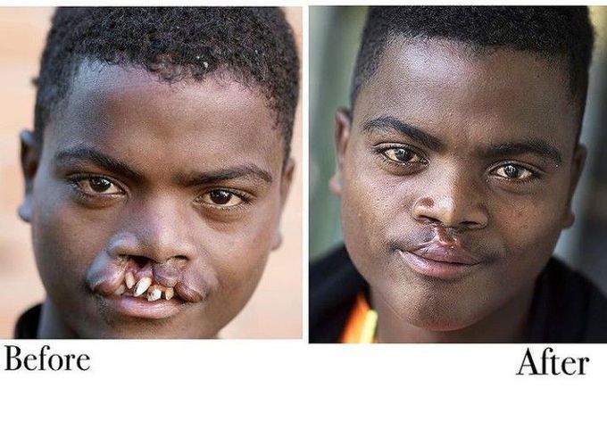Before and after of an extensive Maxillofacial surgery