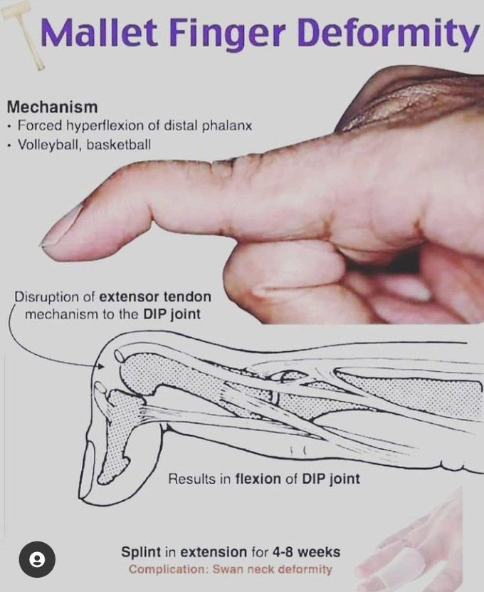 Mallets finger deformity