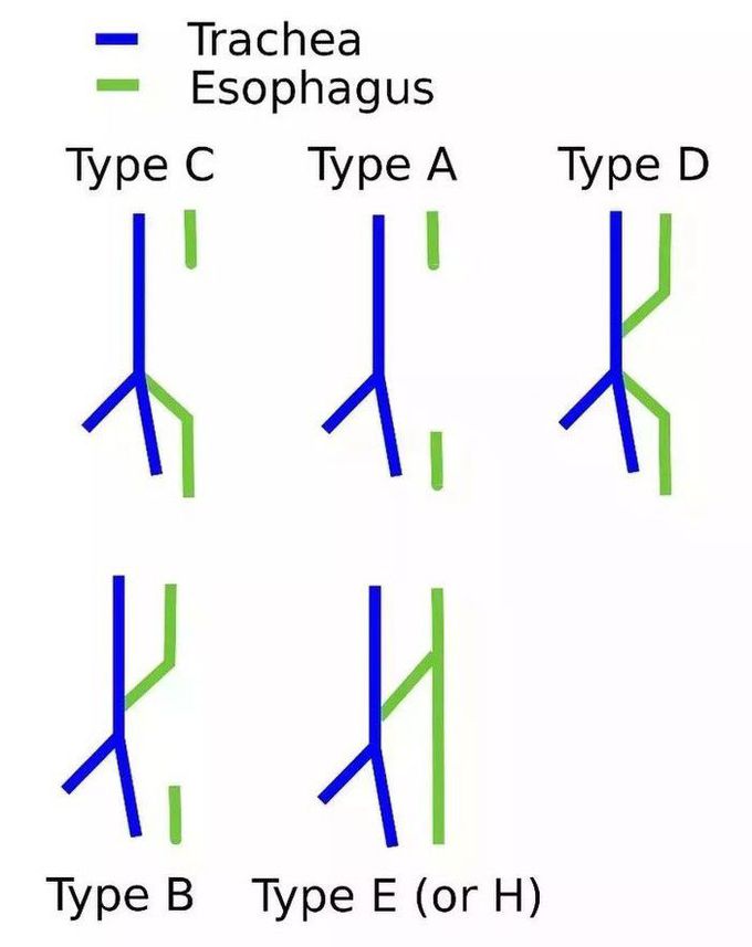 Types of Tracheo-Esophageal Fistula