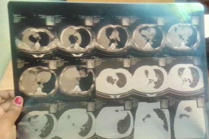 CT scan of a pneumothorax patient