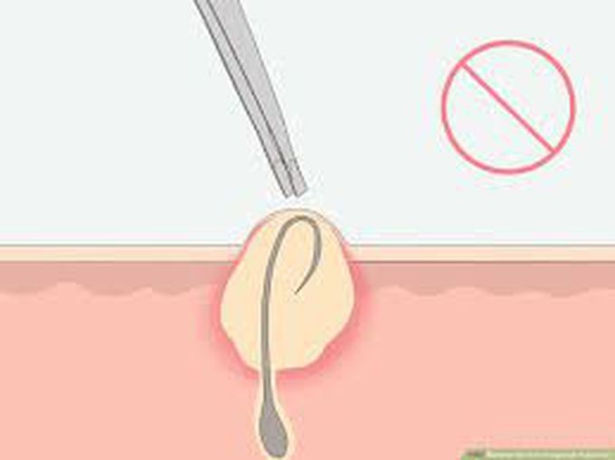 How are ingrown pubic hair treated?