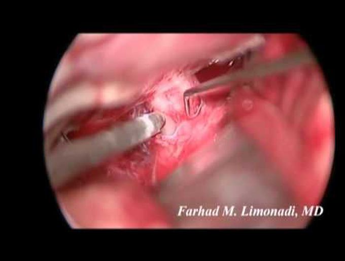Anterior Communicating Artery Aneurysm (brain surgery)