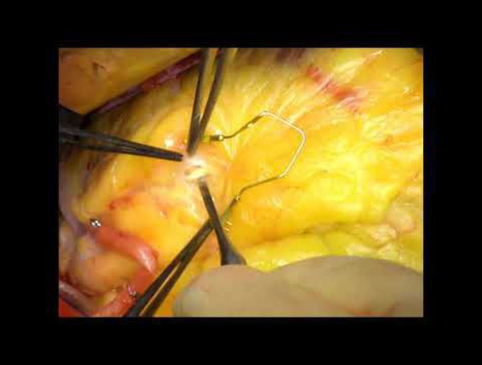 Triple Coronary Endarterectomy in a Patient Undergoing CABG