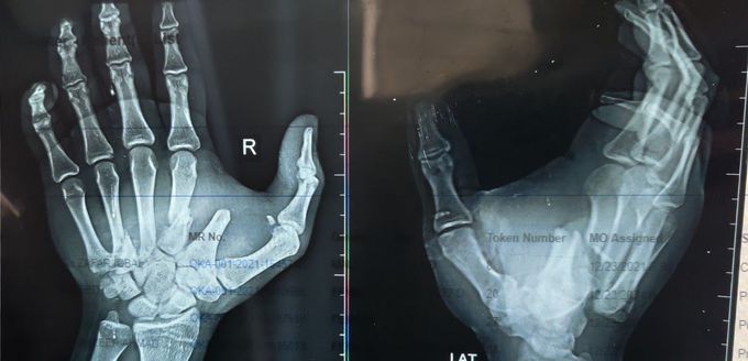 Traumatic fractures of the metacarpels of right hand