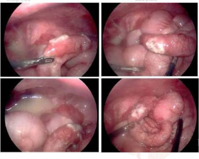 Appendicitis