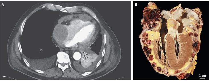 Angiosarcoma Involving the Heart - MEDizzy