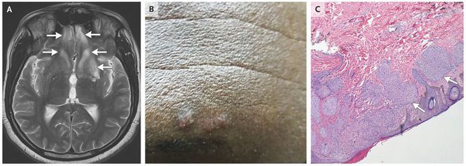Hemichoreoathetosis in Neurosarcoidosis