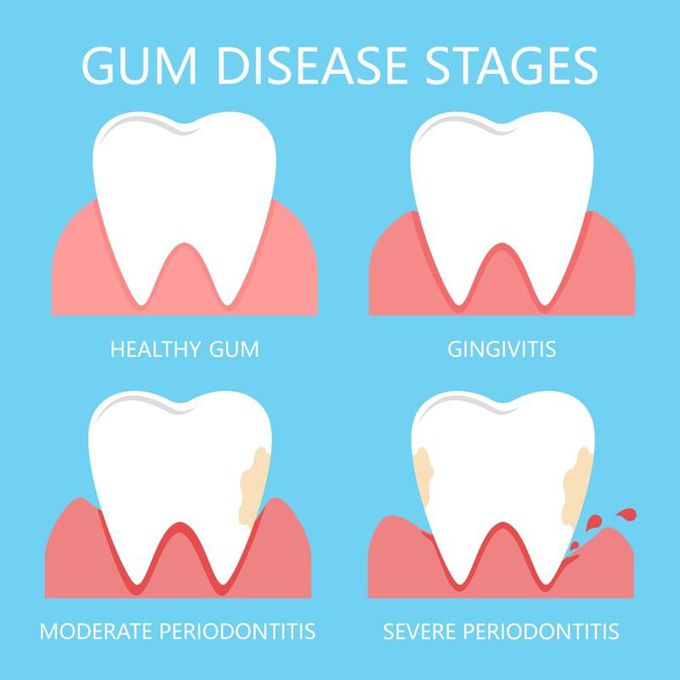 Stages of Periodontitis