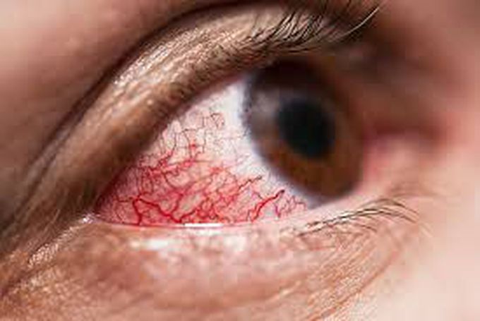 Episcleritis