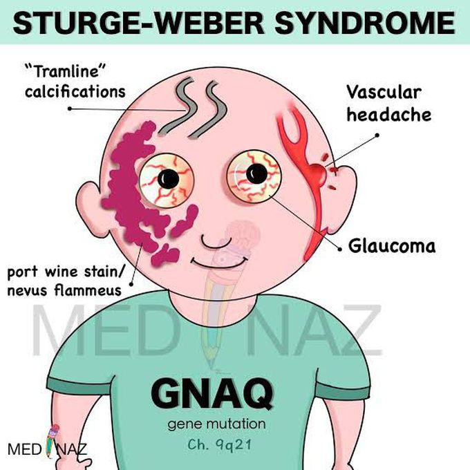 Struge Weber Syndrome