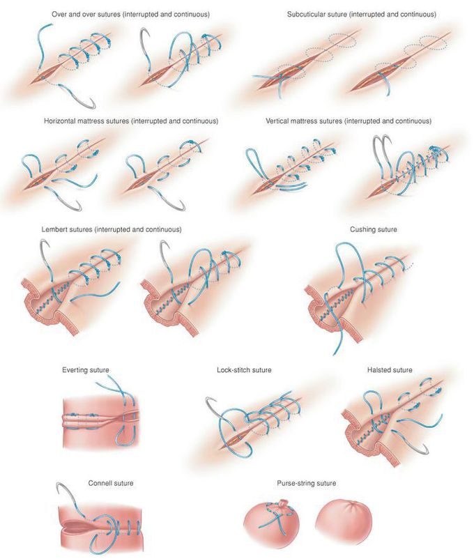 Types of Suturing