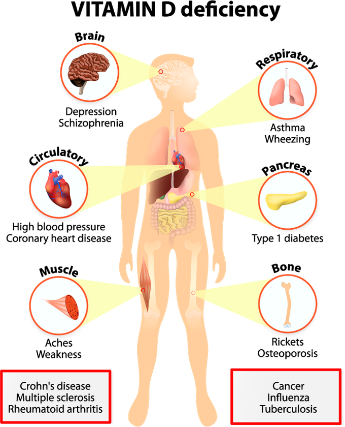 Vitamin D deficiency