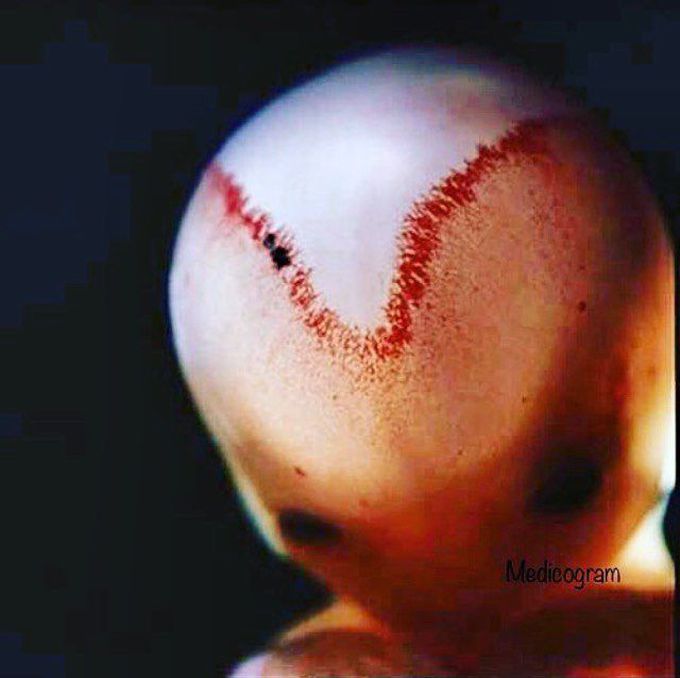 The two skull bones, fusing in a 9-weeks old foetus
