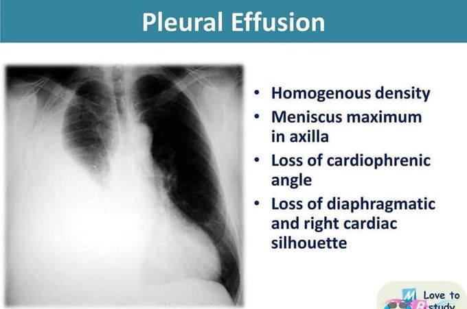 Pleural effusion CXR