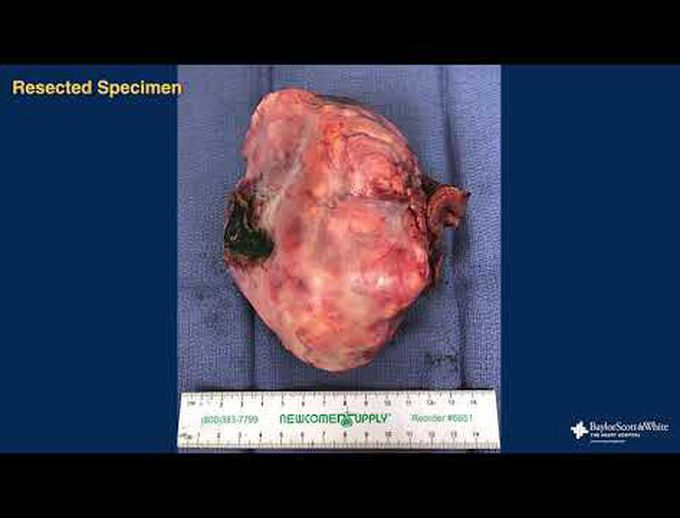 Robot Resection: Solitary Fibrous Tumor