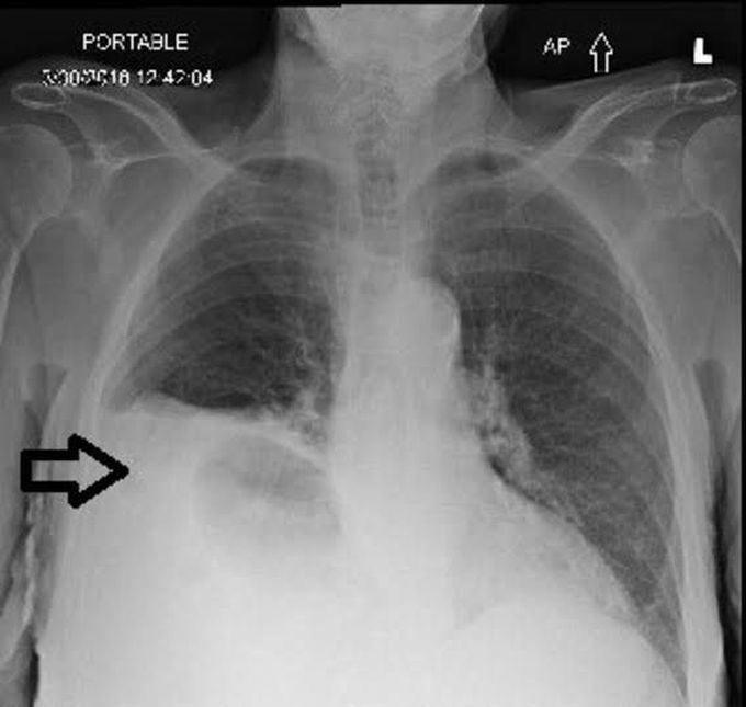 Morgagni Hernia