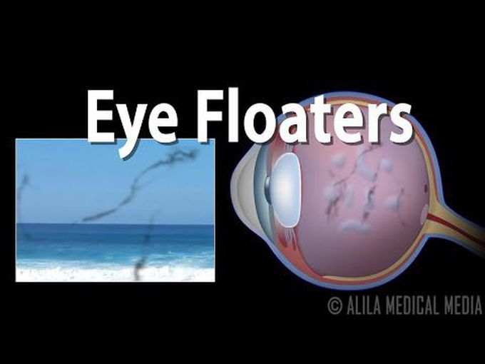 Special senses:
Eye Floaters
