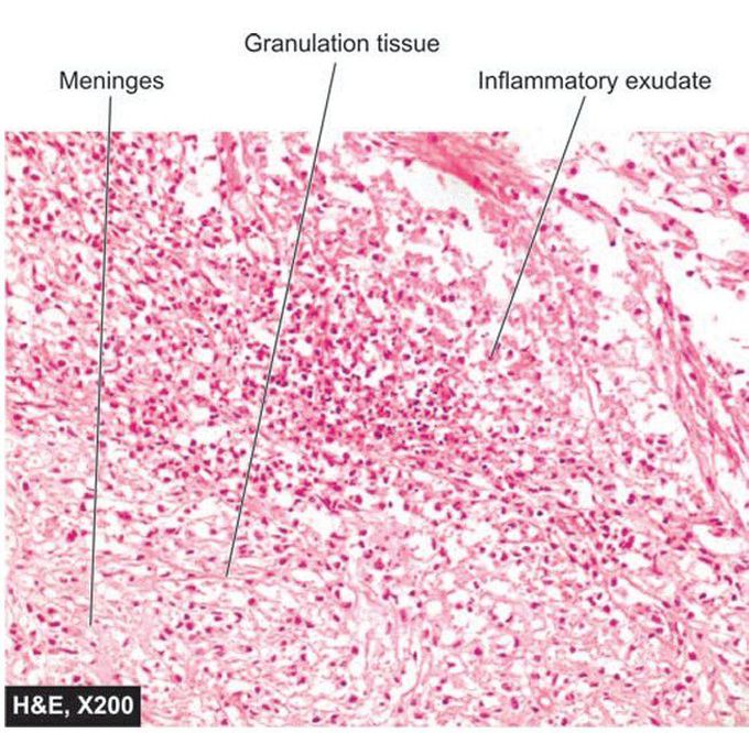 Acute suppurative meningitis.