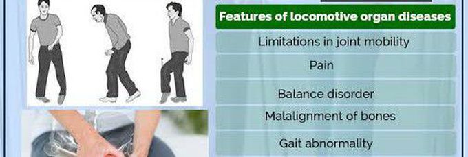 These are the features of Locomotive syndrome