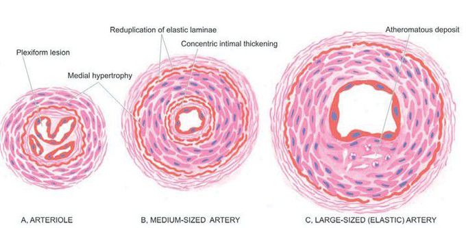 Pulmonary hypertension.