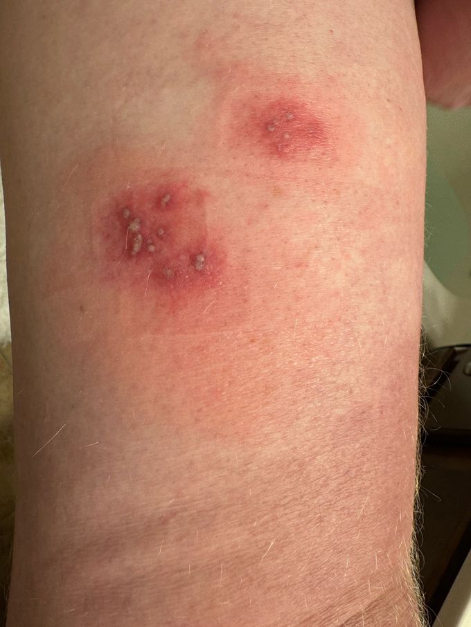 Very painful red blisters on upper thigh of a mans leg. Does anybody know what this could be.