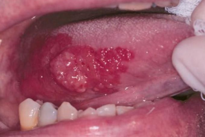 Erythroplakia