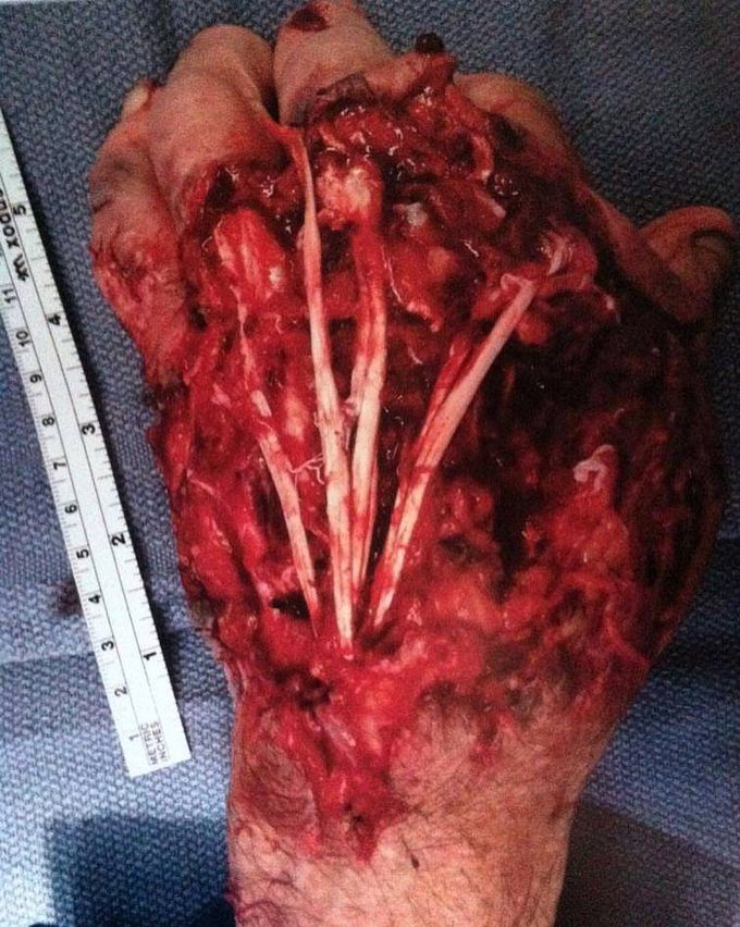 This 86 year old man got his hand caught in a large lawn mower! 