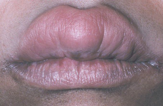 Angioedema