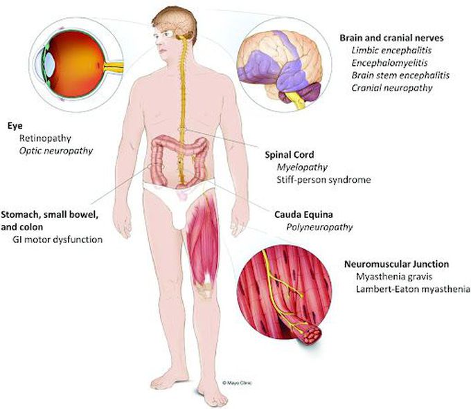 Paraneoplastic Syndrome of Bronchial Carcinoma