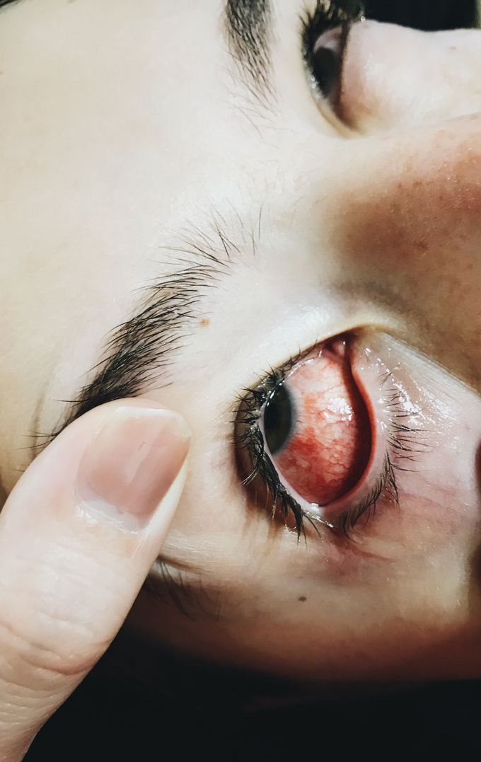 Conjunctivitis
