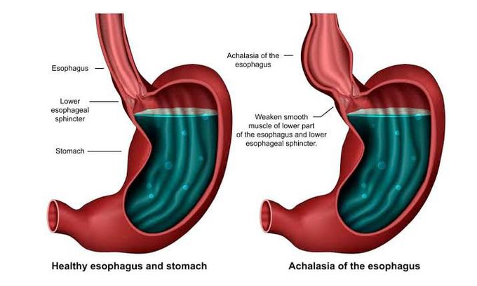 Achalasia