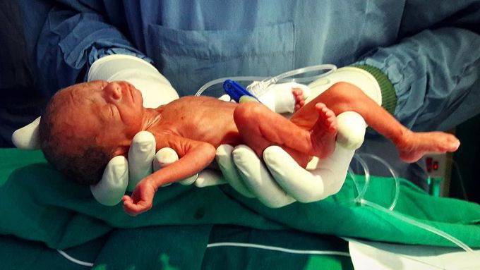 Photograph of a premature baby weighing just over 600 grams!