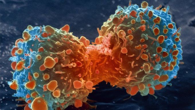 'Handful of changes' make cancer