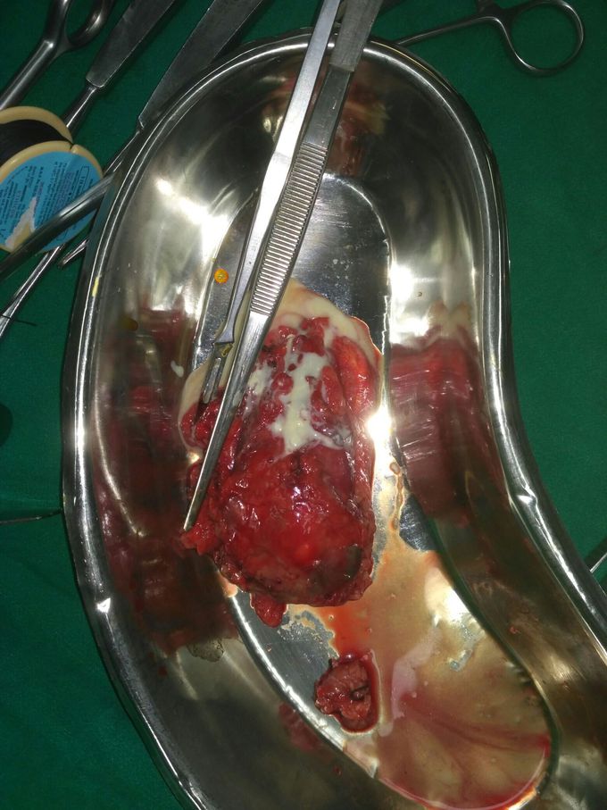 What this specimen ? Wats diagnosis