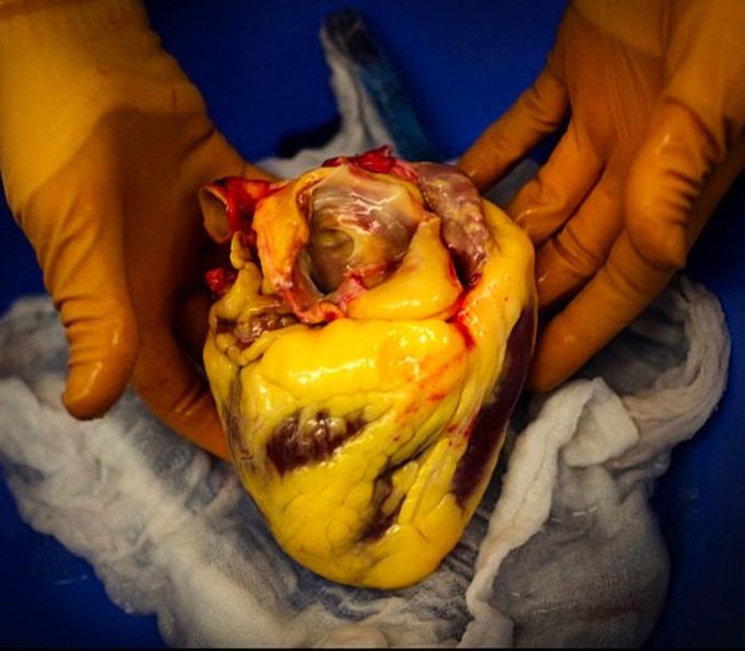 This is a heart from an obese patient, shown covered in its thin layer of epicardial fatty deposits