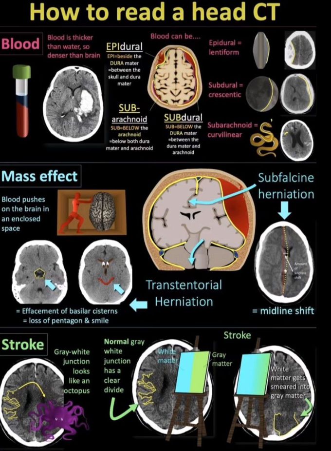 How to read a CT?