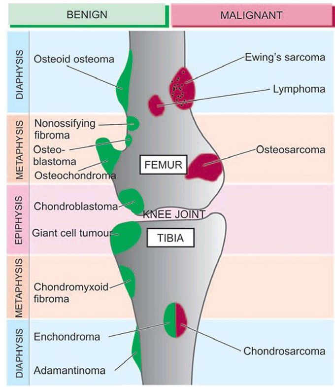 Bone tumours