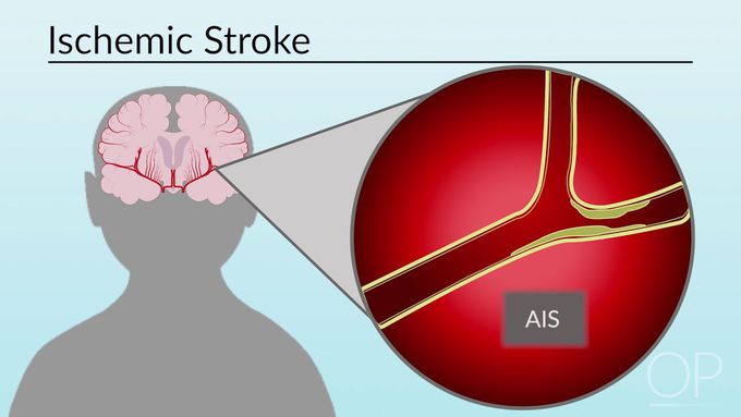 Classification of Stroke" by Miya Bernson-Leung for OPENPediatrics