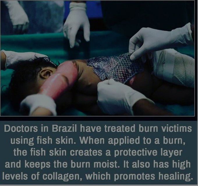 Burn patient is treated by using fish skin....